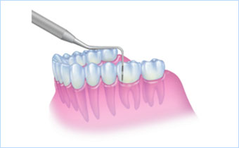 歯周病の治療について基本的な流れ