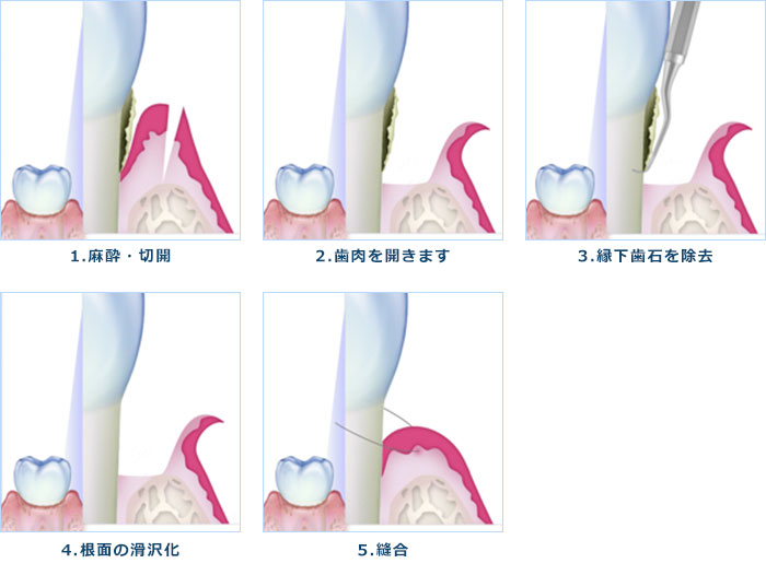 歯周病の治療について基本的な流れ
