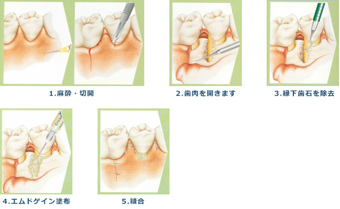 歯周病の治療について基本的な流れ