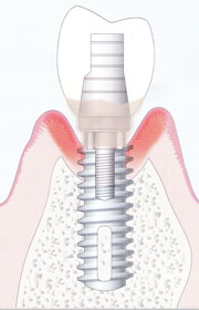 歯周病とインプラントの関係