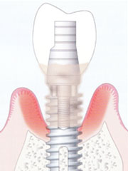 歯周病とインプラントの関係