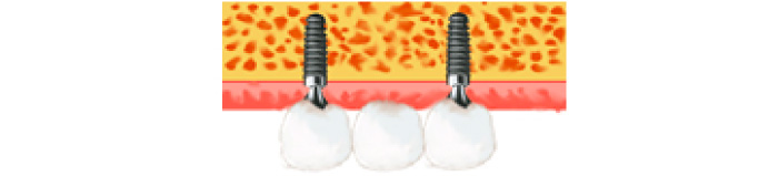 骨の厚みが足りない上の奥歯に奥歯を造成してから、2本埋入し、上部構造を3本つなぎのブリッジにした例