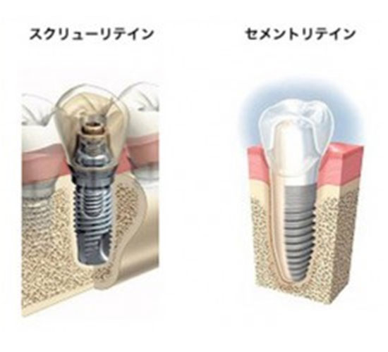 全てのインプラントの上部構造にジルコニアを使用します